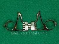上顎拡大装置の固定式の装置
