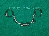 下顎拡大装置の床タイプの装置