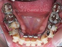 下顎拡大装置を床タイプを口腔内に装着した状態