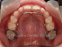 リンガルアーチを口腔内に装着した状態