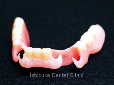 ノンクラスプ義歯 | 診療科目 | 石塚歯科医院