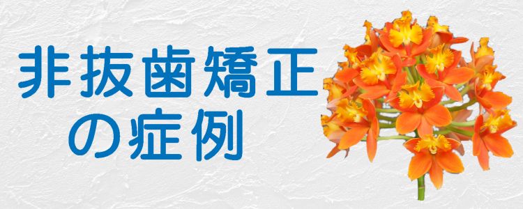 非抜歯矯正の症例