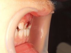 外傷で前歯がぐらぐらした症例・横