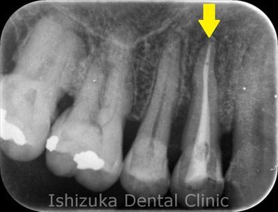 歯根 膜 炎 レントゲン で わかる