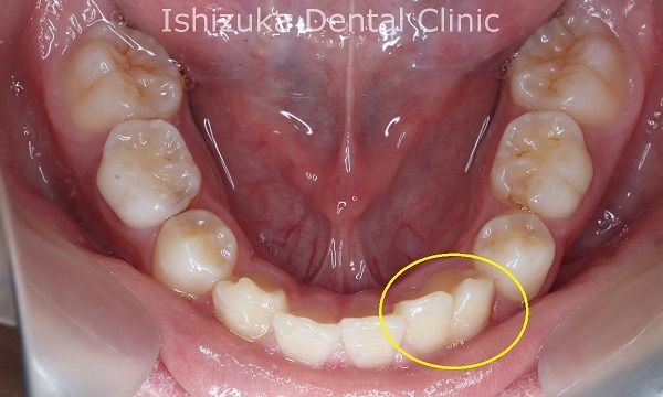 癒合歯の見分け方とケア 治療の方法 石塚歯科医院
