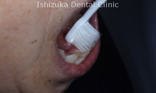 歯の裏側の磨き方