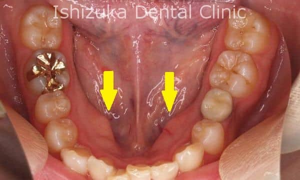 母指球隆起の痛みや腫れの原因は何ですか?