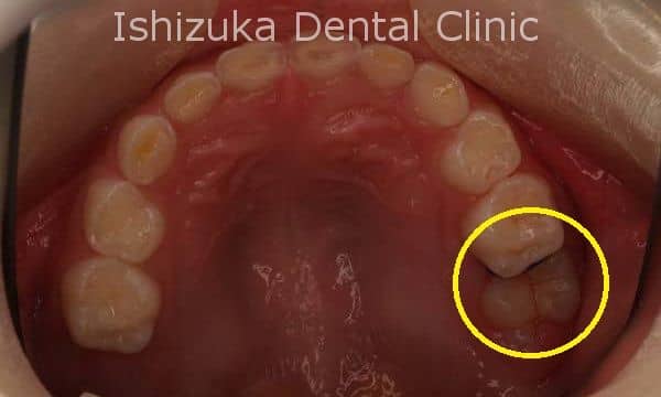 6才臼歯は大切 虫歯予防と治療の方法 石塚歯科医院