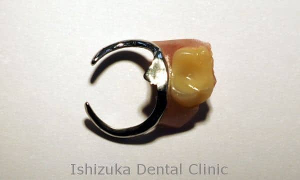 金具(クラスプ)が折れた入れ歯2
