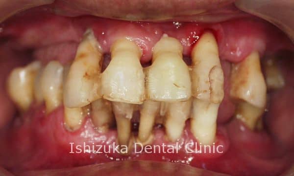  3. 1日1回フロスをする